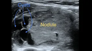 Thyroid Cystic Nodule RFA Ablation - Live Images - Top Specialist