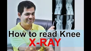 Learn to read X-ray Online | Meaning Of X ray [HINDI], Knee x ray reading, Knee Osteoarthritis X ray