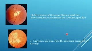 Neuro-ophthalmology part 2