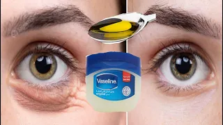 In 3 days completely remove under eye bags |  dark circles, wrinkles  |  puffy eyelids