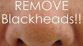 DIY how to REMOVE Blackheads Using an EGG!!