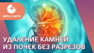 👌 Современный метод удаления камней из почек при помощи лазера. Удалить камни из почек. 18+