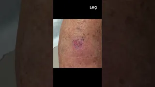 What Does Common Skin Cancer Look Like On...  Volume 2