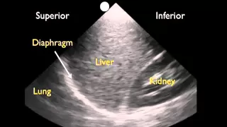 How To: Ultrasound Detection of Pleural Fluid Case Study Video