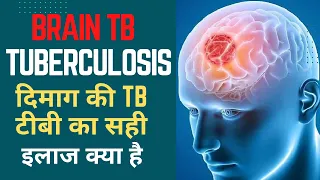Brain Tb Tuberculosis दिमाग की TB टीबी का सही इलाज क्या है Dr. Naveen Kumar Ailawadi