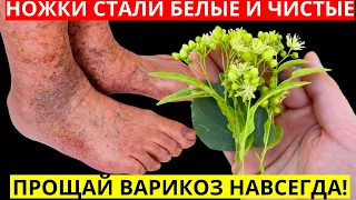 УБИЙЦА ВАРИКОЗА И СОСУДИСТЫХ ЗВЕЗДОЧЕК! За 5 минут в день Ножки СТАЛИ ЛЕГКИЕ И ЧИСТЫЕ!