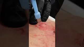 DOUBLE BACK CYST | PT 2