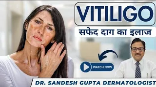 White Patches On Skin (Vitiligo) || White Spots.Easy Permanent Cure Explained By Dr. Sandesh Gupta
