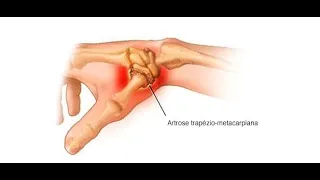 EXERCÍCIOS RIZARTROSE do POLEGAR ARTROSE DOR DEDÃO da MÃO - Clínica de Fisioterapia Dr. Robson Sitta