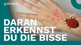 Bettwanzen? Daran erkennst du die Bisse