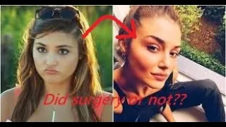 Did Hayat have surgery??? | Reason of Hayat (hande) look??| Surgery of Hande Ercel