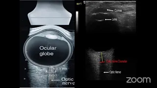 ultrasonographic optic nerve sheath diameter to assess ICP