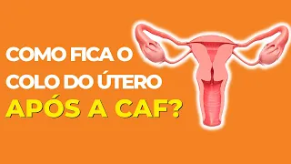 Como fica o colo do útero após a CAF?