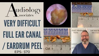 VERY DIFFICULT FULL EAR CANAL/EARDRUM PEEL - EP570