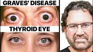 Graves’ Disease & Thyroid Eye Differences Explaind by a Surgeon