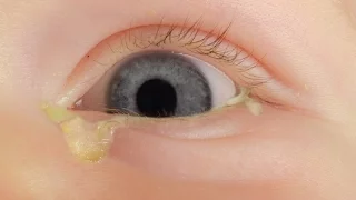 How to treat a sticky eye in a baby