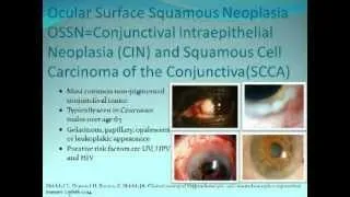 Ocular Surface Squamous Neoplasia  |  Presenter: Carol L. Karp, M.D.