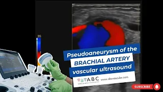 Pseudoaneurysm of the brachial artery: vascular ultrasound