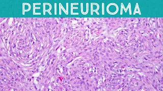 Perineurioma (swirling whorling benign & beautiful soft tissue tumor)