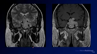 Neuroradiology Board Review - Brain Tumors - Case 5