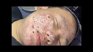 Perfect time every day with Video Popping Tons Of Blackheads