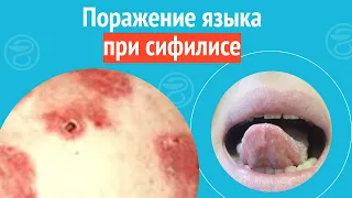 👅 Поражение языка при сифилисе. Клинический случай №1394