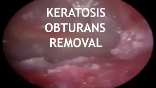 MOST DIFFICULT EXTRACTION OF KERATOSIS OBTURANS - UNEDITED !!  #454