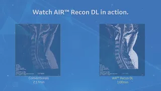 Leverage the Power of A.I. in MRI Scans with AIR™ Recon DL