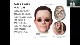 Head injury | signs & symptoms | treatment | complications | full lecture | medical | surgery |