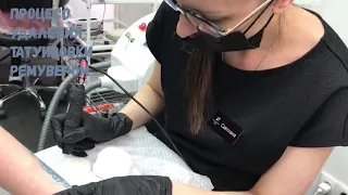 Процесс удаления татуировки ремувером