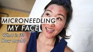 Microneedling Treatment Before and After | Acne Scar Removal