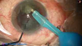 Mohanta's Lens Tilt Technique (MLTT) -  Dr Pradip Mohanta, 25 Feb, 2024