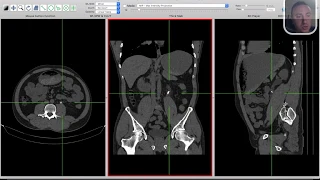 GUT | Renal stones | 1 | How to report CT assessment of renal stones