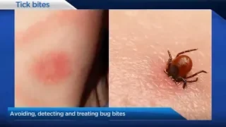 Detecting & Treating Bug Bites (Ticks, Lyme Disease)