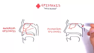 Clinical Anatomy -  Nasal Cavity and Nose bleeds