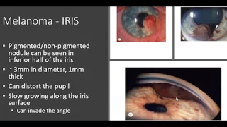 Ocular tumours