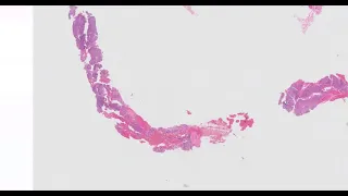 Solitary fibrous tumor with an epithelioid phenotype