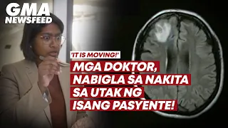 Mga doktor, nabigla sa nakita sa utak ng isang pasyente! | GMA News Feed
