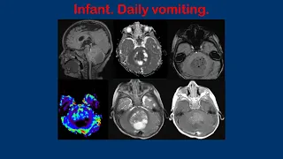 Atypical teratoid/rhabdoid tumors