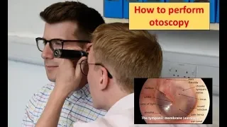 How to perform Otoscopy (Ear Exam)