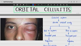 Orbital Cellulitis | Postseptal Cellulitis || Ophtha Lecture