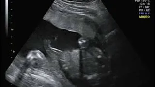 It's a Girl!!!  Ultrasound