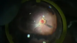 PPV for vitreous haemorrhage with suspected endophthalmitis from needle prick trauma