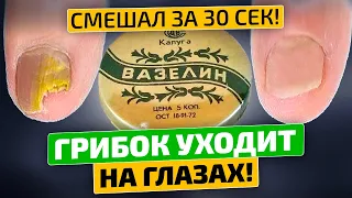 Грибок исчез! Кто придумал мешать вазелин с ...? За 2 раза помогло!