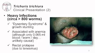 Helminths Trichuris