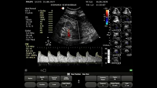 УЗИ сосудов почек норма 2020 06 16 11 21 30