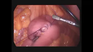 Laparoscopic Roux-en-Y Gastric Bypass (Graphic)