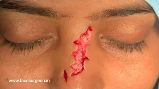 Zig Zag Jigsaw Puzzle Type Scar Removed off Nose with Z plasty