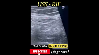 Diagnosis ? USS RIF - Practical case - Radiology