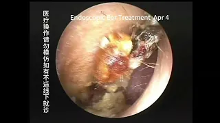 Hard object blockage under extremely narrow conditions